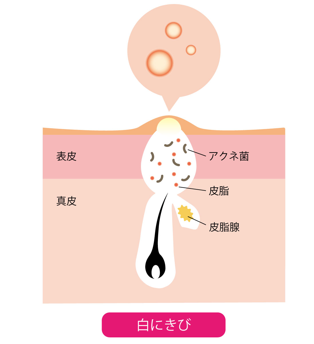 白ニキビの画像