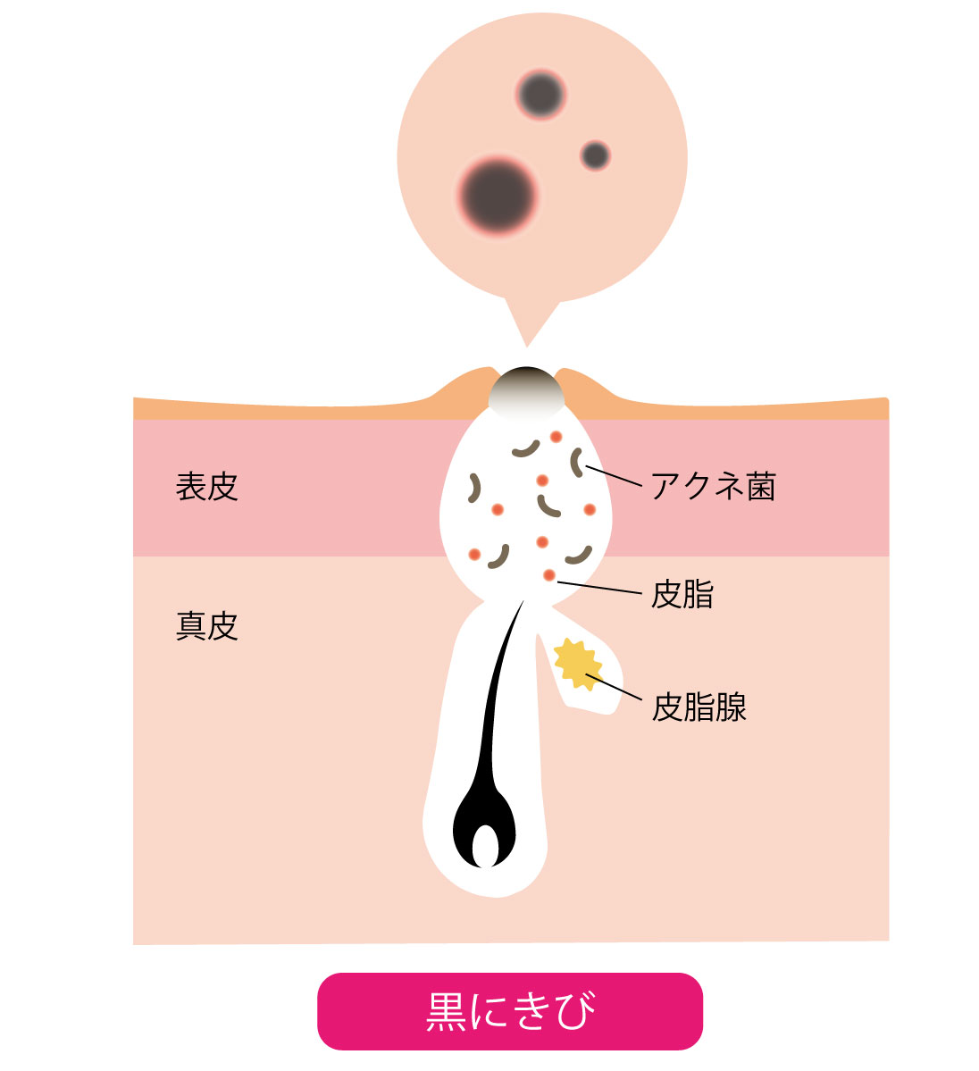 黒ニキビの画像