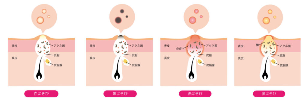 にきび