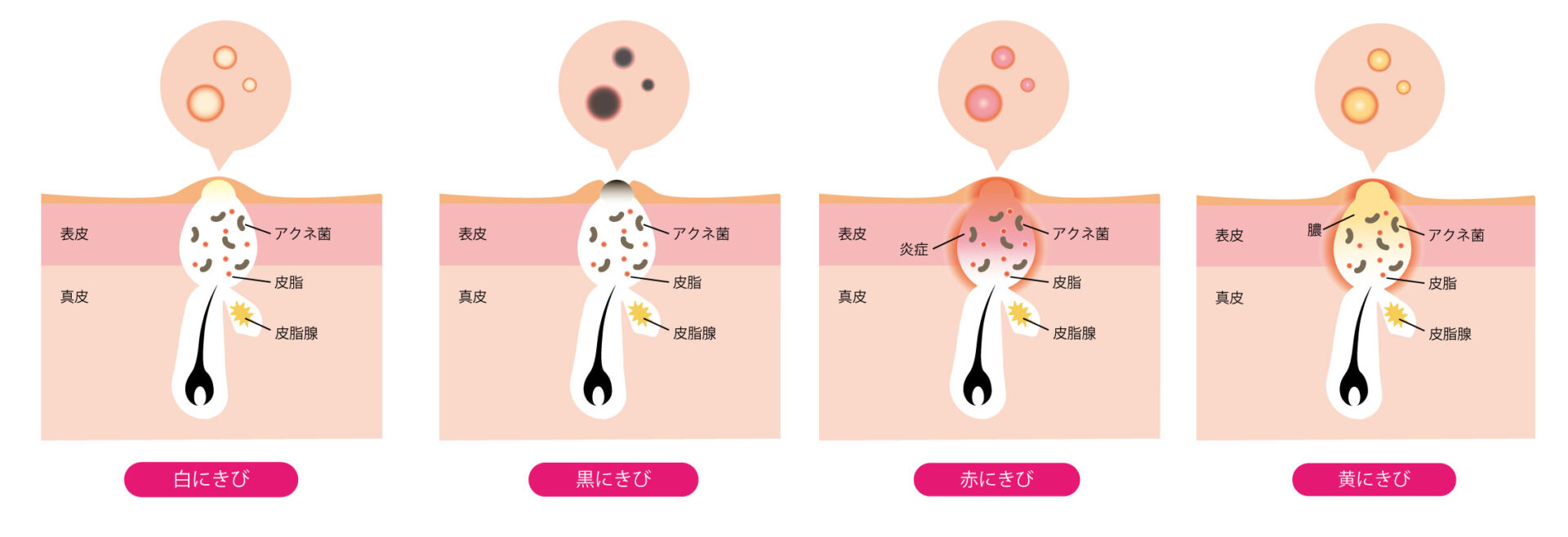 ニキビの種類がわかる画像
