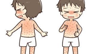 はしか（麻疹）の予防と漢方的アプローチ：免疫力アップからワクチンまで
