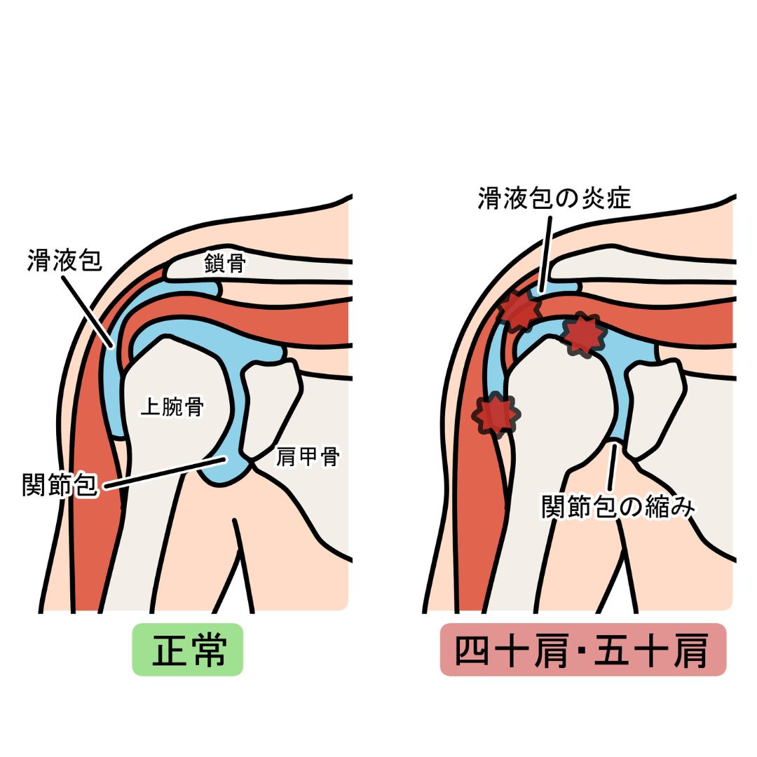 五十肩の肩の痛みイメージ